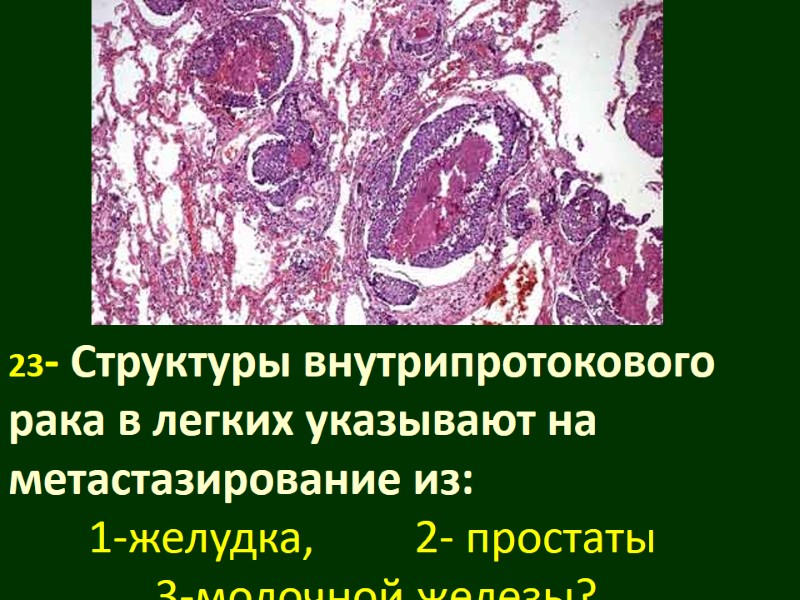 23- Структуры внутрипротокового рака в легких указывают на метастазирование из:  1-желудка,  